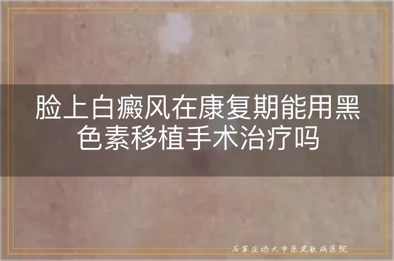 脸上白癜风在康复期能用黑色素移植手术治疗吗