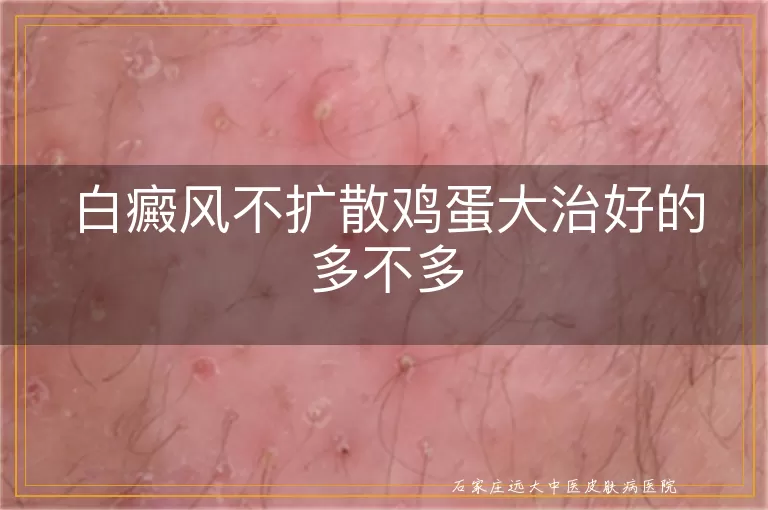 白癜风不扩散鸡蛋大治好的多不多