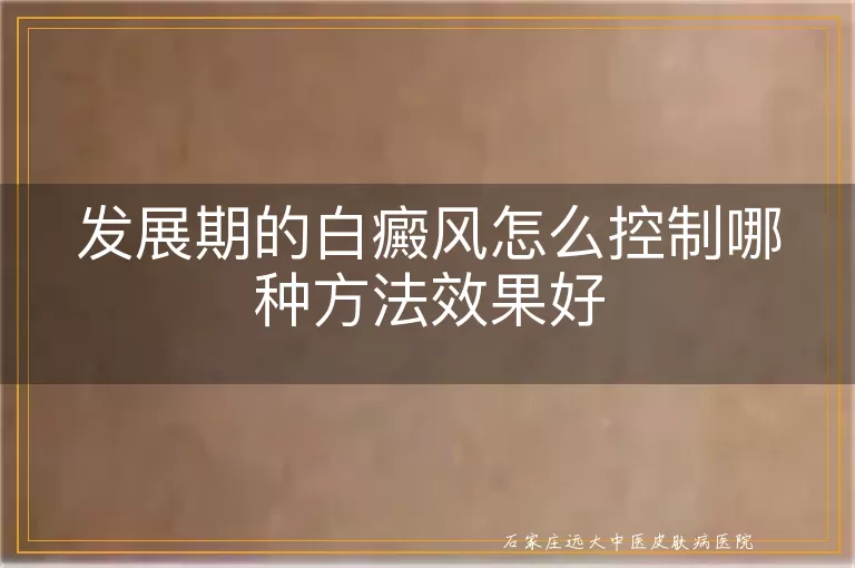 发展期的白癜风怎么控制哪种方法效果好