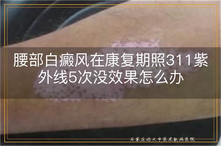 腰部白癜风在康复期照311紫外线5次没效果怎么办