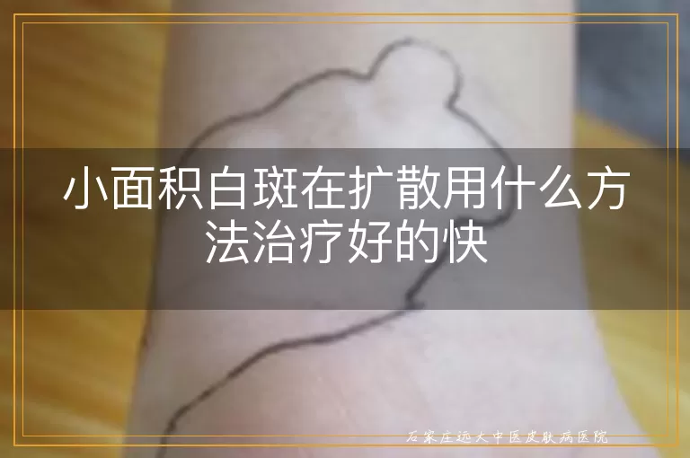 小面积白斑在扩散用什么方法治疗好的快