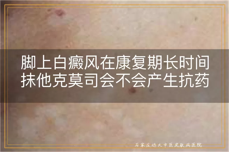 脚上白癜风在康复期长时间抹他克莫司会不会产生抗药性