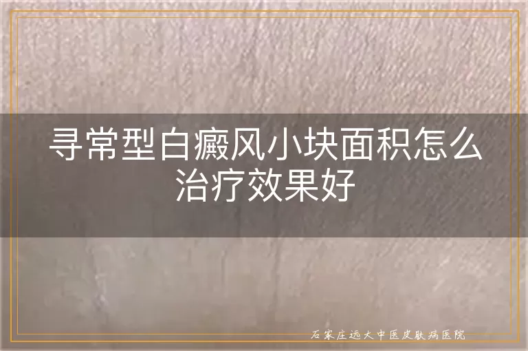 寻常型白癜风小块面积怎么治疗效果好