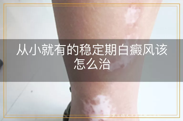 从小就有的稳定期白癜风该怎么治