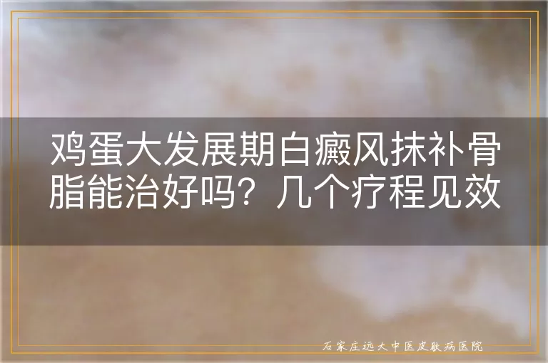 鸡蛋大发展期白癜风抹补骨脂能治好吗？几个疗程见效？