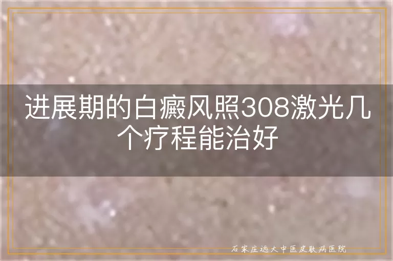 进展期的白癜风照308激光几个疗程能治好