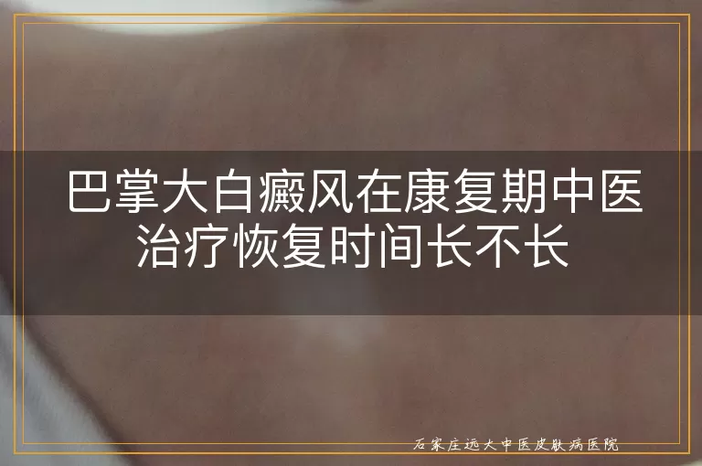 巴掌大白癜风在康复期中医治疗恢复时间长不长