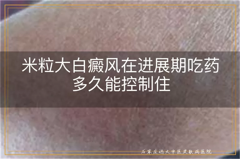 米粒大白癜风在进展期吃药多久能控制住