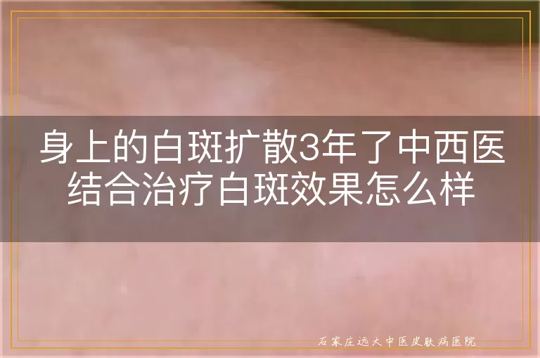 身上的白斑扩散3年了中西医结合治疗白斑效果怎么样