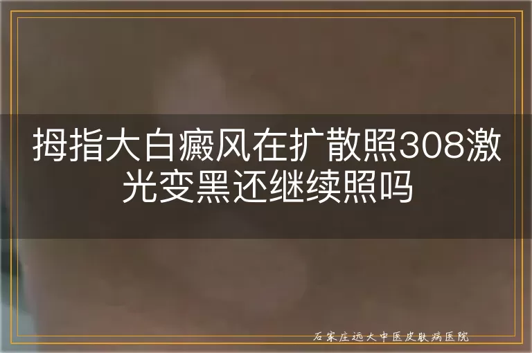 拇指大白癜风在扩散照308激光变黑还继续照吗