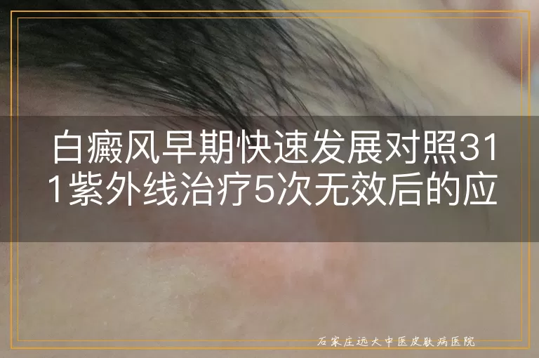 白癜风早期快速发展对照311紫外线治疗5次无效后的应对策略