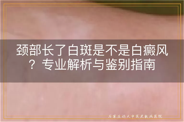 颈部长了白斑是不是白癜风？专业解析与鉴别指南