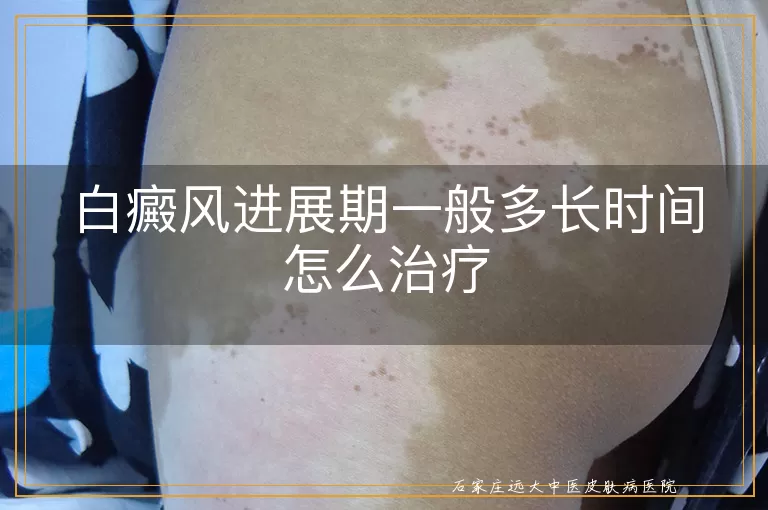 白癜风进展期一般多长时间怎么治疗