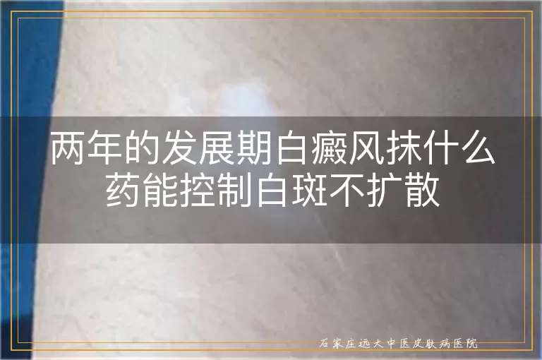 两年的发展期白癜风抹什么药能控制白斑不扩散