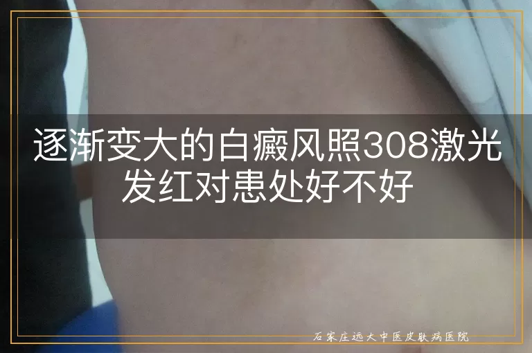 逐渐变大的白癜风照308激光发红对患处好不好