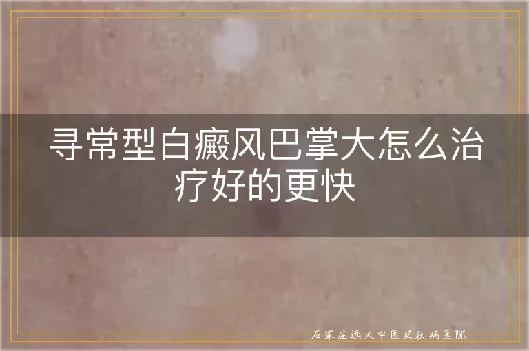 寻常型白癜风巴掌大怎么治疗好的更快