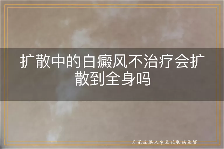 扩散中的白癜风不治疗会扩散到全身吗