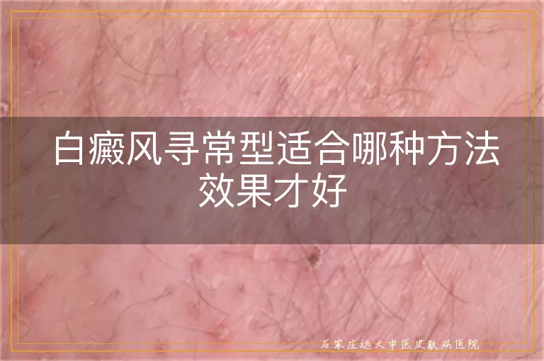 白癜风寻常型适合哪种方法效果才好