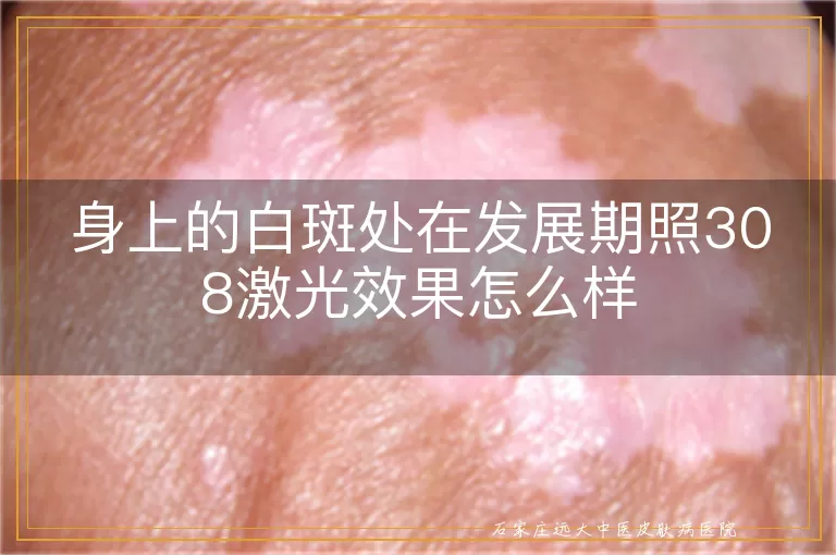 身上的白斑处在发展期照308激光效果怎么样