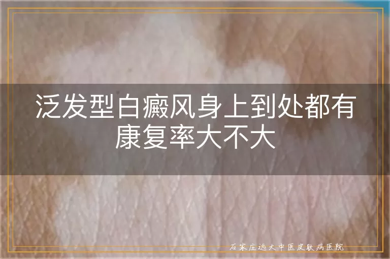 泛发型白癜风身上到处都有康复率大不大