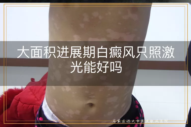 大面积进展期白癜风只照激光能好吗