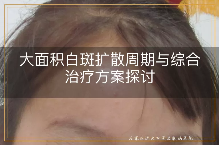 大面积白斑扩散周期与综合治疗方案探讨