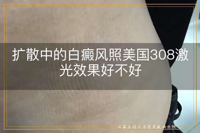 扩散中的白癜风照美国308激光效果好不好