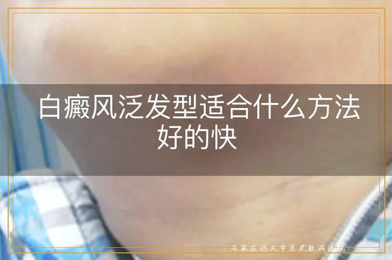 白癜风泛发型适合什么方法好的快