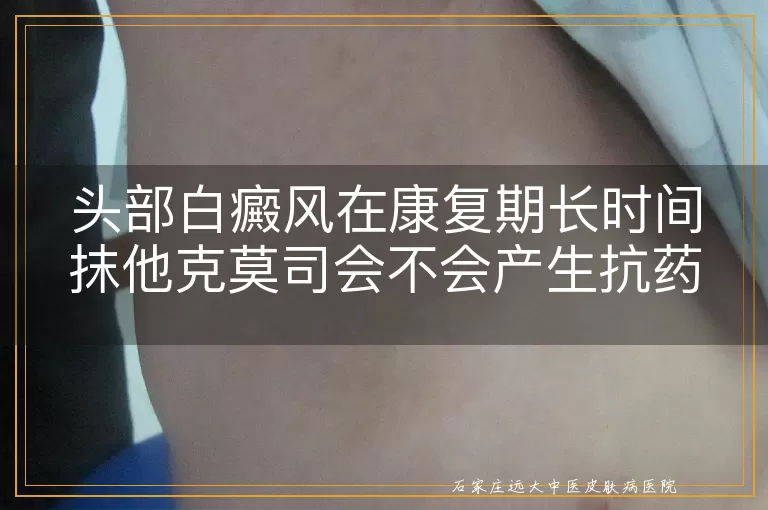头部白癜风在康复期长时间抹他克莫司会不会产生抗药性