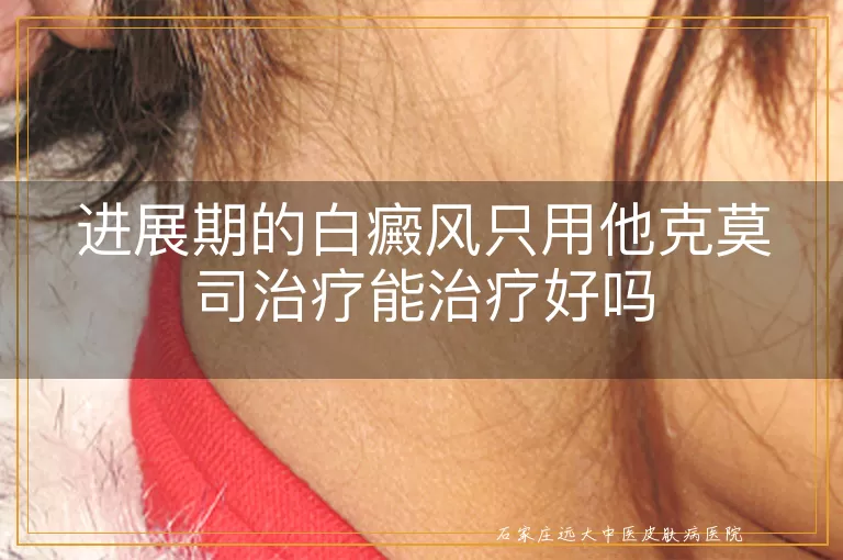 进展期的白癜风只用他克莫司治疗能治疗好吗