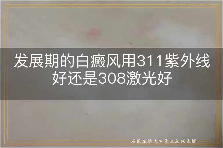 发展期的白癜风用311紫外线好还是308激光好