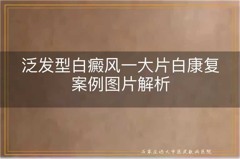 泛发型白癜风一大片白康复案例图片解析