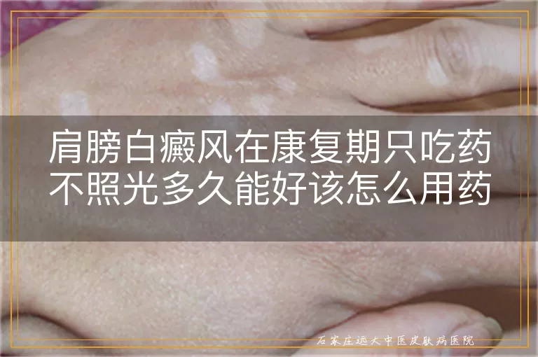 肩膀白癜风在康复期只吃药不照光多久能好该怎么用药