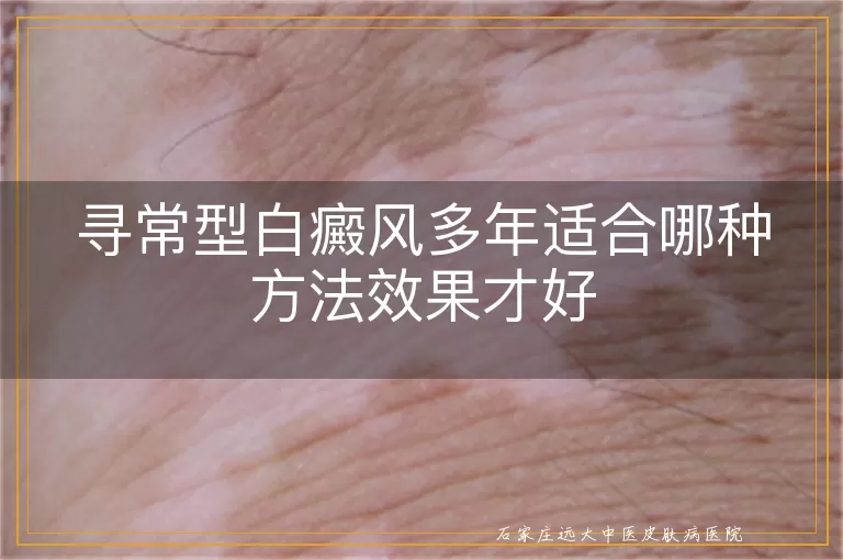 寻常型白癜风多年适合哪种方法效果才好
