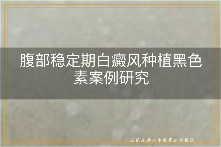 腹部稳定期白癜风种植黑色素案例研究