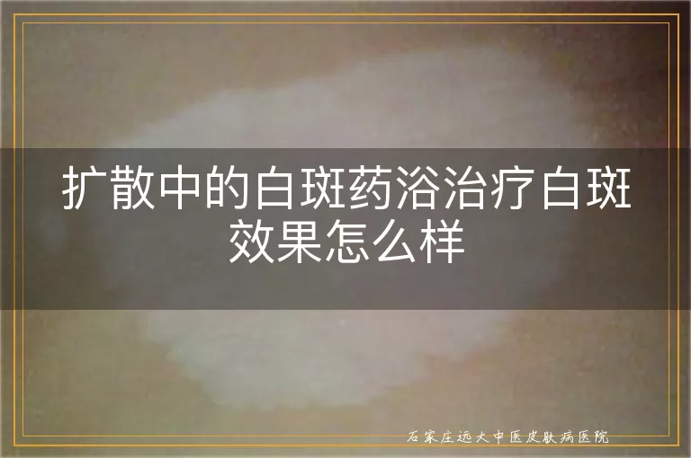 扩散中的白斑药浴治疗白斑效果怎么样