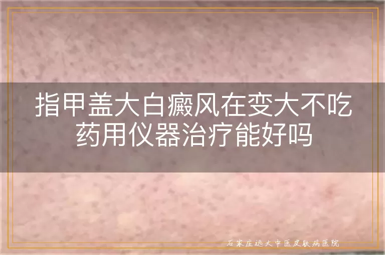 指甲盖大白癜风在变大不吃药用仪器治疗能好吗