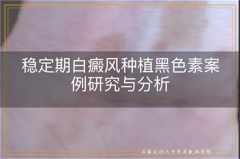 稳定期白癜风种植黑色素案例研究与分析