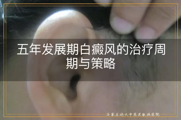 五年发展期白癜风的治疗周期与策略
