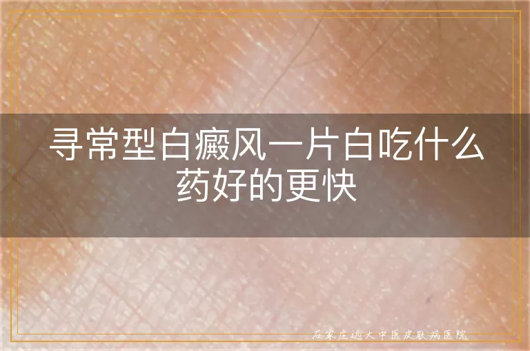 寻常型白癜风一片白吃什么药好的更快