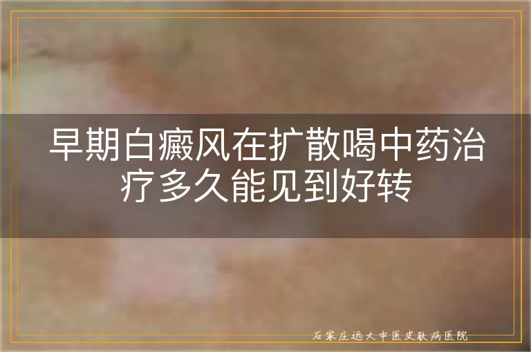 早期白癜风在扩散喝中药治疗多久能见到好转