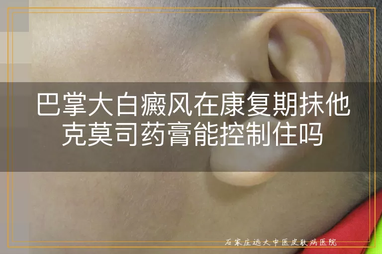 巴掌大白癜风在康复期抹他克莫司药膏能控制住吗