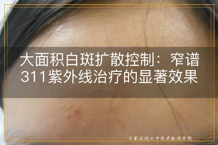 大面积白斑扩散控制：窄谱311紫外线治疗的显著效果