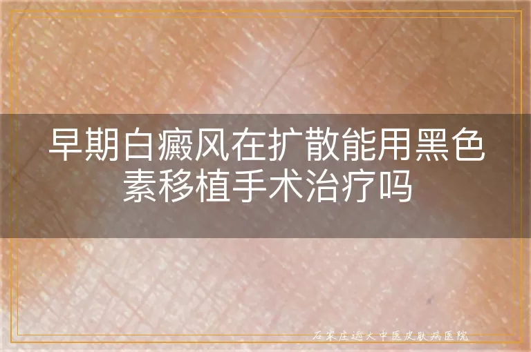 早期白癜风在扩散能用黑色素移植手术治疗吗