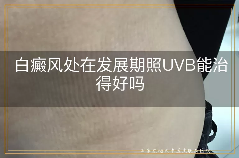 白癜风处在发展期照UVB能治得好吗