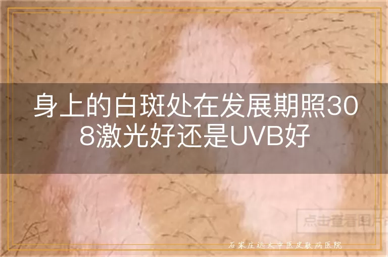 身上的白斑处在发展期照308激光好还是UVB好