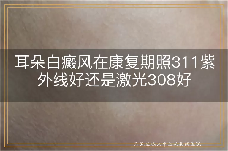 耳朵白癜风在康复期照311紫外线好还是激光308好