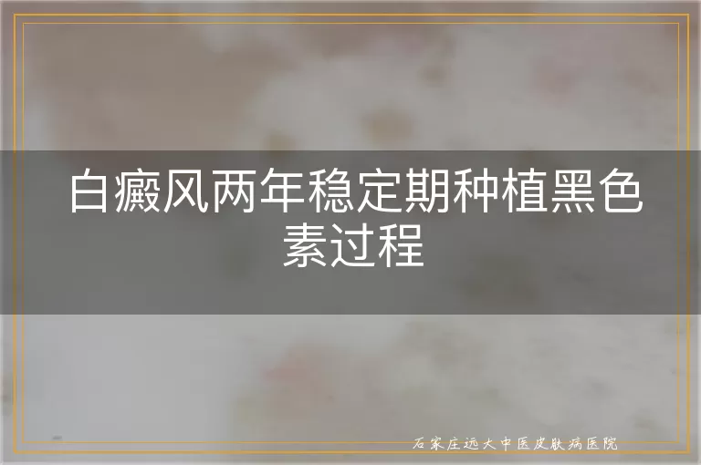 白癜风两年稳定期种植黑色素过程