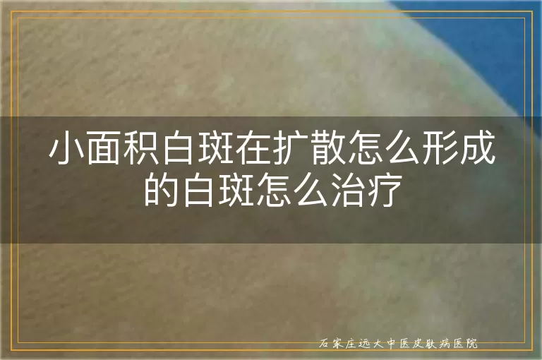 小面积白斑在扩散怎么形成的白斑怎么治疗