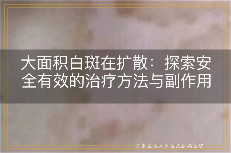大面积白斑在扩散：探索安全有效的治疗方法与副作用评估